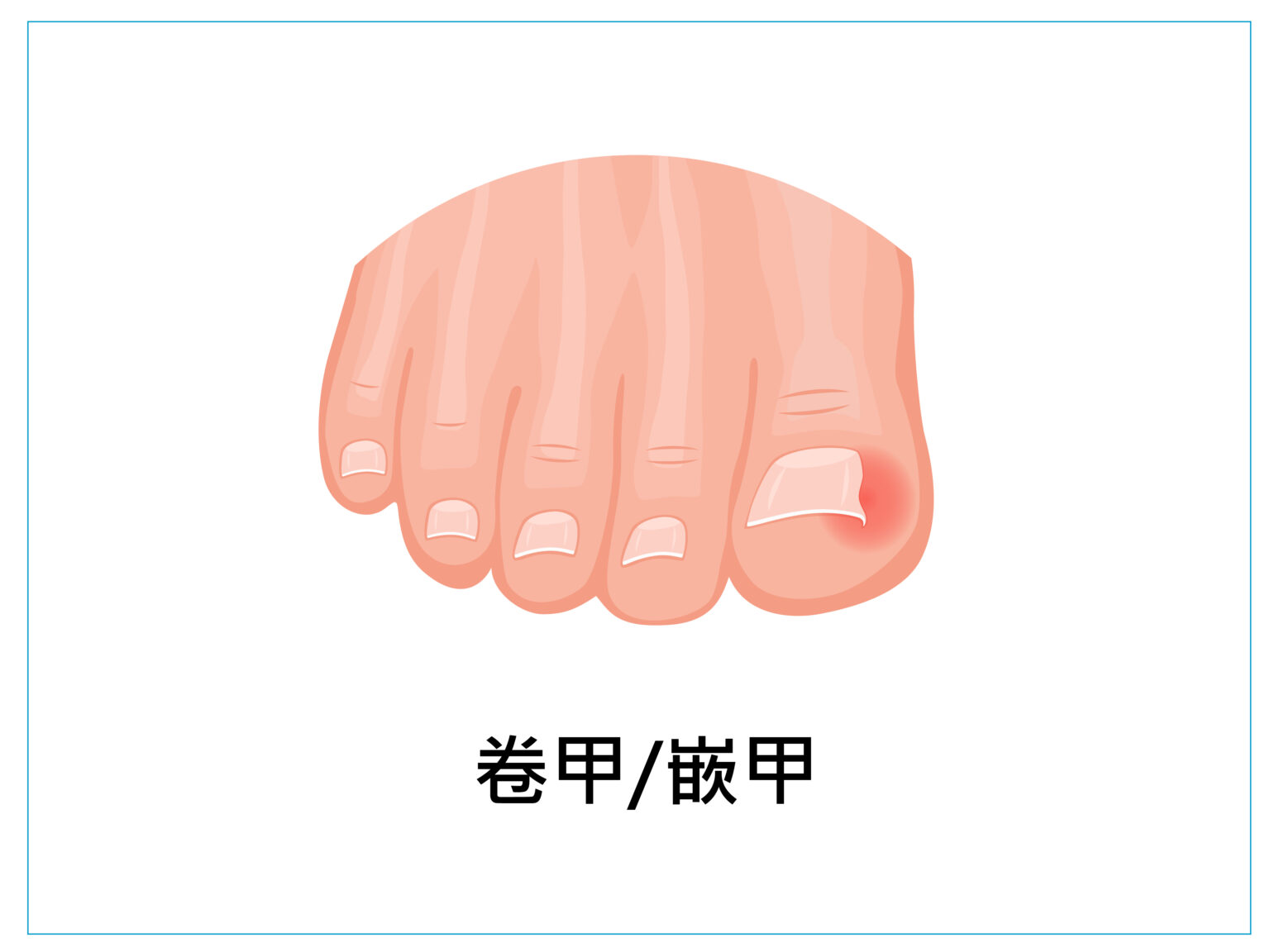 美甲 健甲 凍甲 灰指甲 耐恩適 nail nails 拇指外翻 甲溝炎 嵌甲