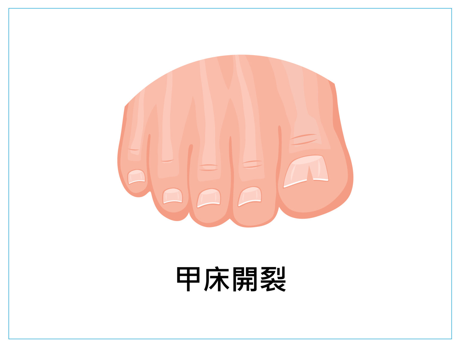 美甲 健甲 凍甲 灰指甲 耐恩適 nail nails 拇指外翻 甲溝炎 嵌甲