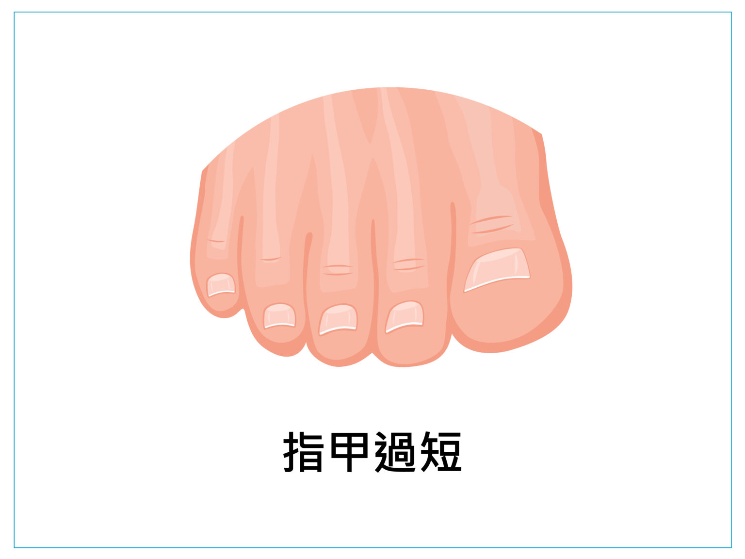 美甲 健甲 凍甲 灰指甲 耐恩適 nail nails 拇指外翻 甲溝炎 嵌甲