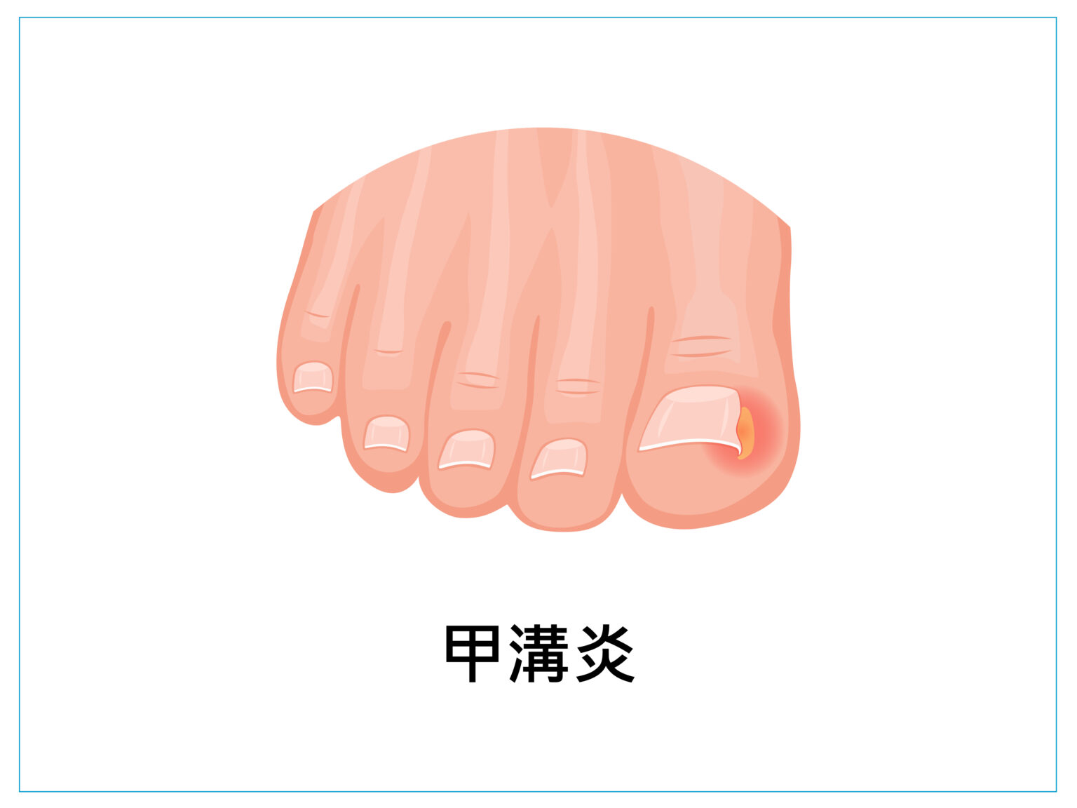 美甲 健甲 凍甲 灰指甲 耐恩適 nail nails 拇指外翻 甲溝炎 嵌甲