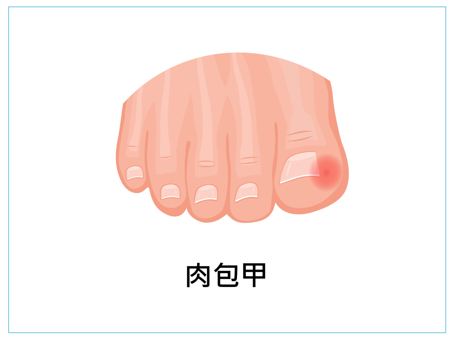 美甲 健甲 凍甲 灰指甲 耐恩適 nail nails 拇指外翻 甲溝炎 嵌甲