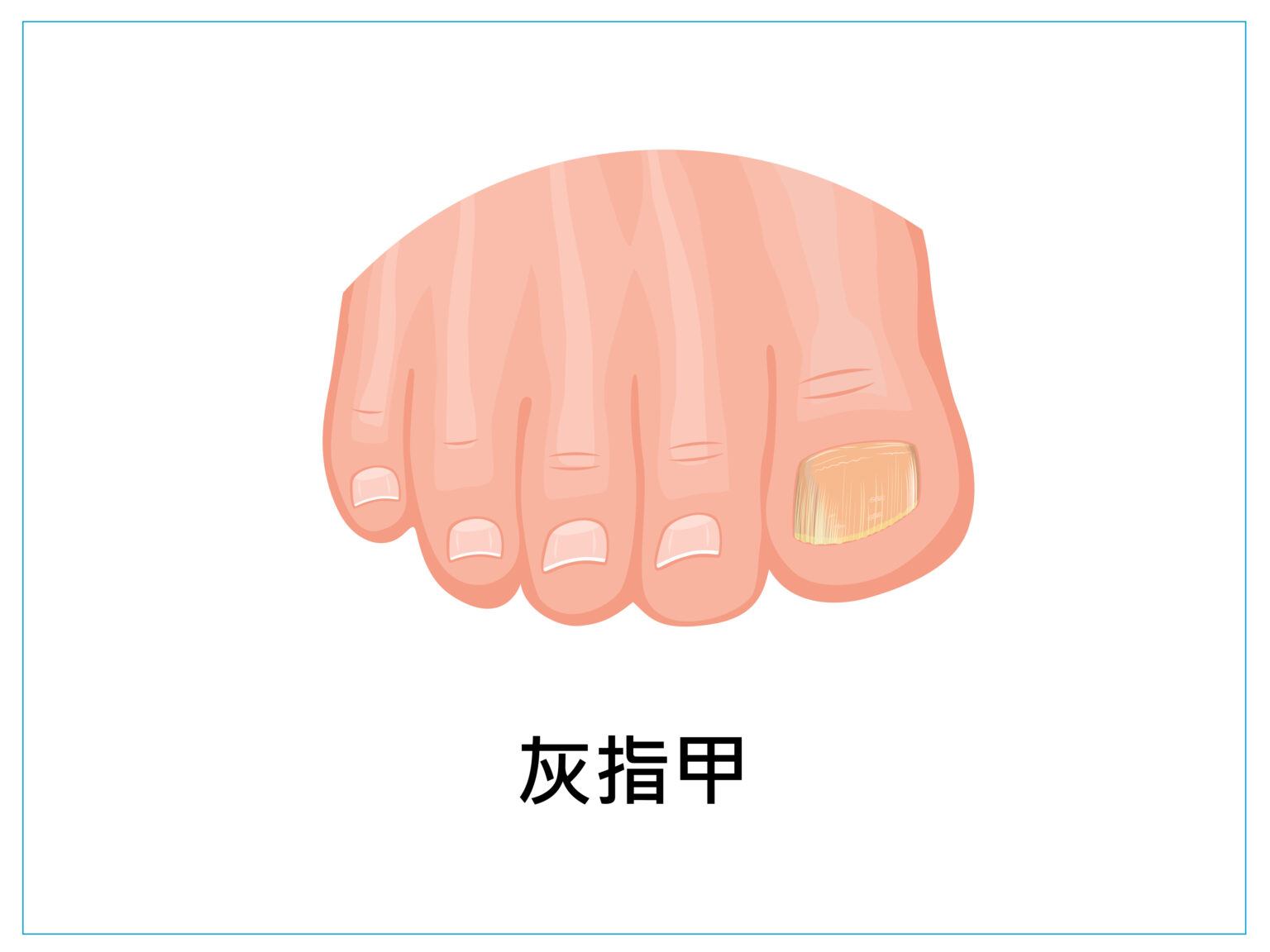 美甲 健甲 凍甲 灰指甲 耐恩適 nail nails 拇指外翻 甲溝炎 嵌甲